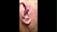 Play Grandad has a brobdingnagian hickey zit on the ear